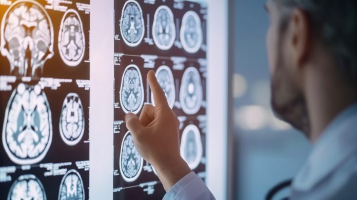 inteligencia-artificial-impulsa-deteccion-temprana-y-avances-en-el-tratamiento-del-parkinson