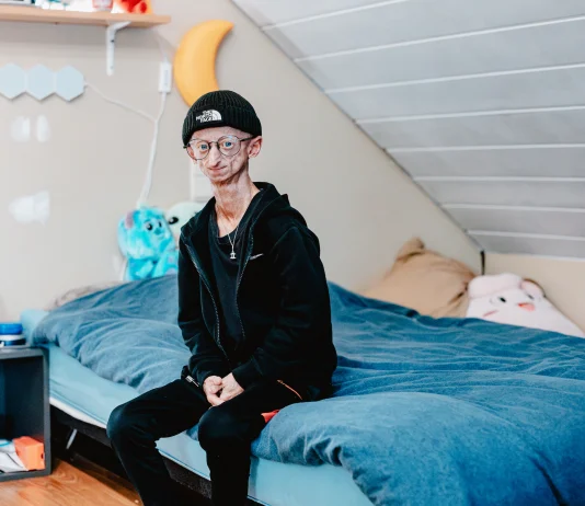 Muere a los 28 años Michiel Vandeweert, joven con progeria que inspiró a miles de personas muere-a-los-28-anos-michiel-vandeweert,-joven-con-progeria-que-inspiro-a-miles-de-personas