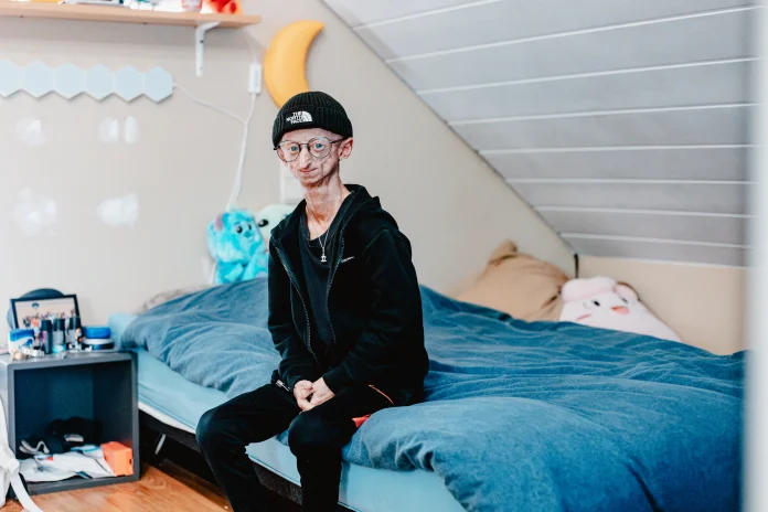 muere-a-los-28-anos-michiel-vandeweert,-joven-con-progeria-que-inspiro-a-miles-de-personas muere-a-los-28-anos-michiel-vandeweert,-joven-con-progeria-que-inspiro-a-miles-de-personas